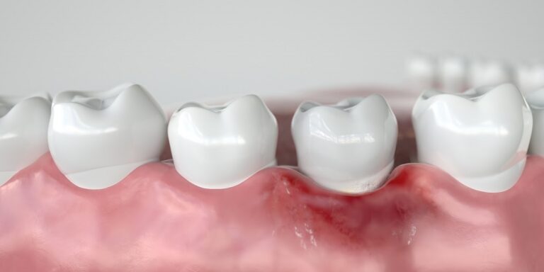 ascesso-dentale-come-prevenire