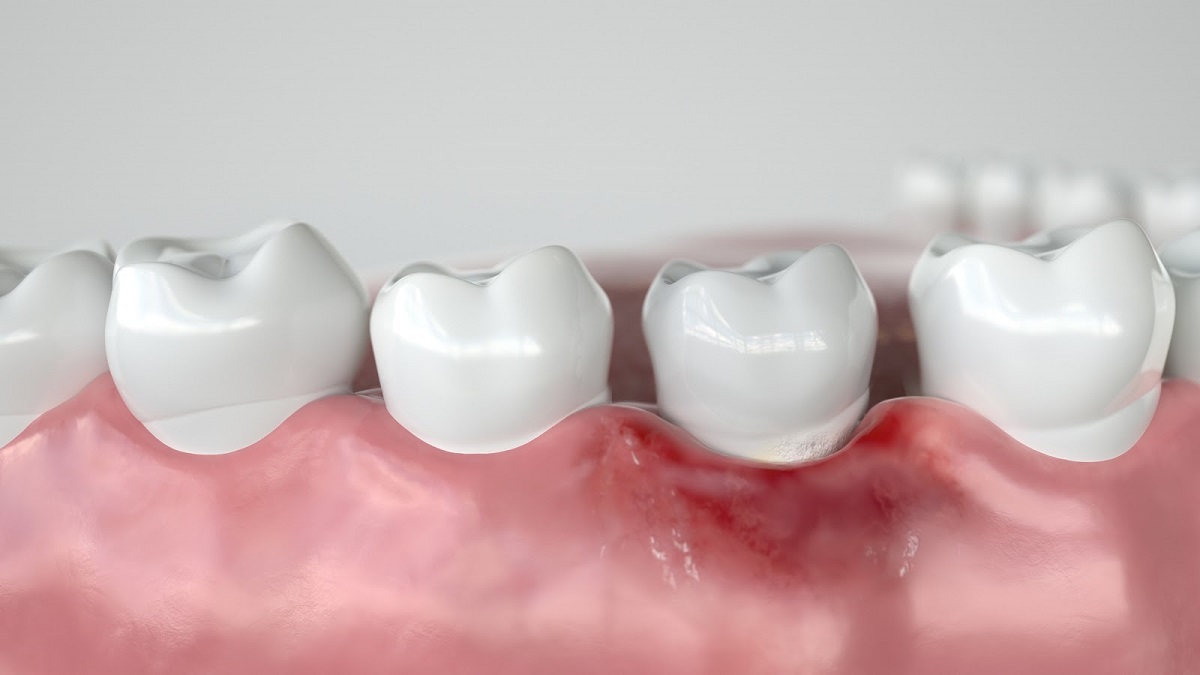 ascesso-dentale-come-prevenire