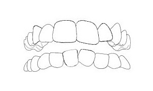 affollamento-dentale affollamento dentale