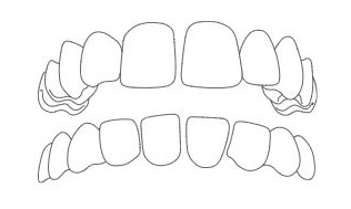 spazi-denti spazi denti