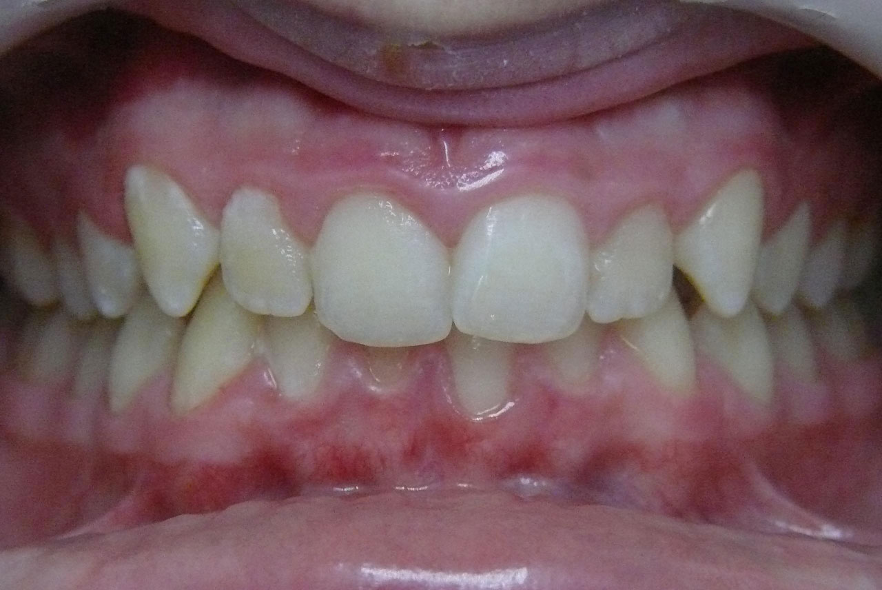 ir prima low
